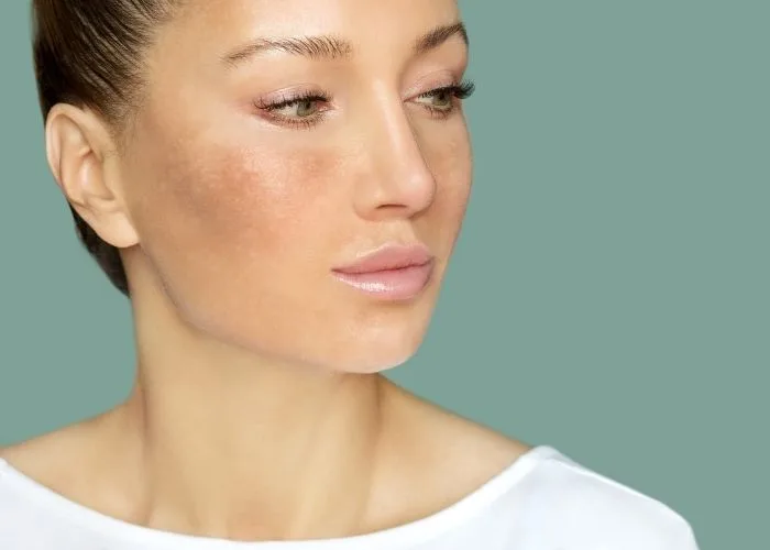 Melasma.Dermatologia. Dermatologia em São Paulo - SP. Dermatologista perto de mim. Dermatologista zona sul. Dermatologista Brooklin