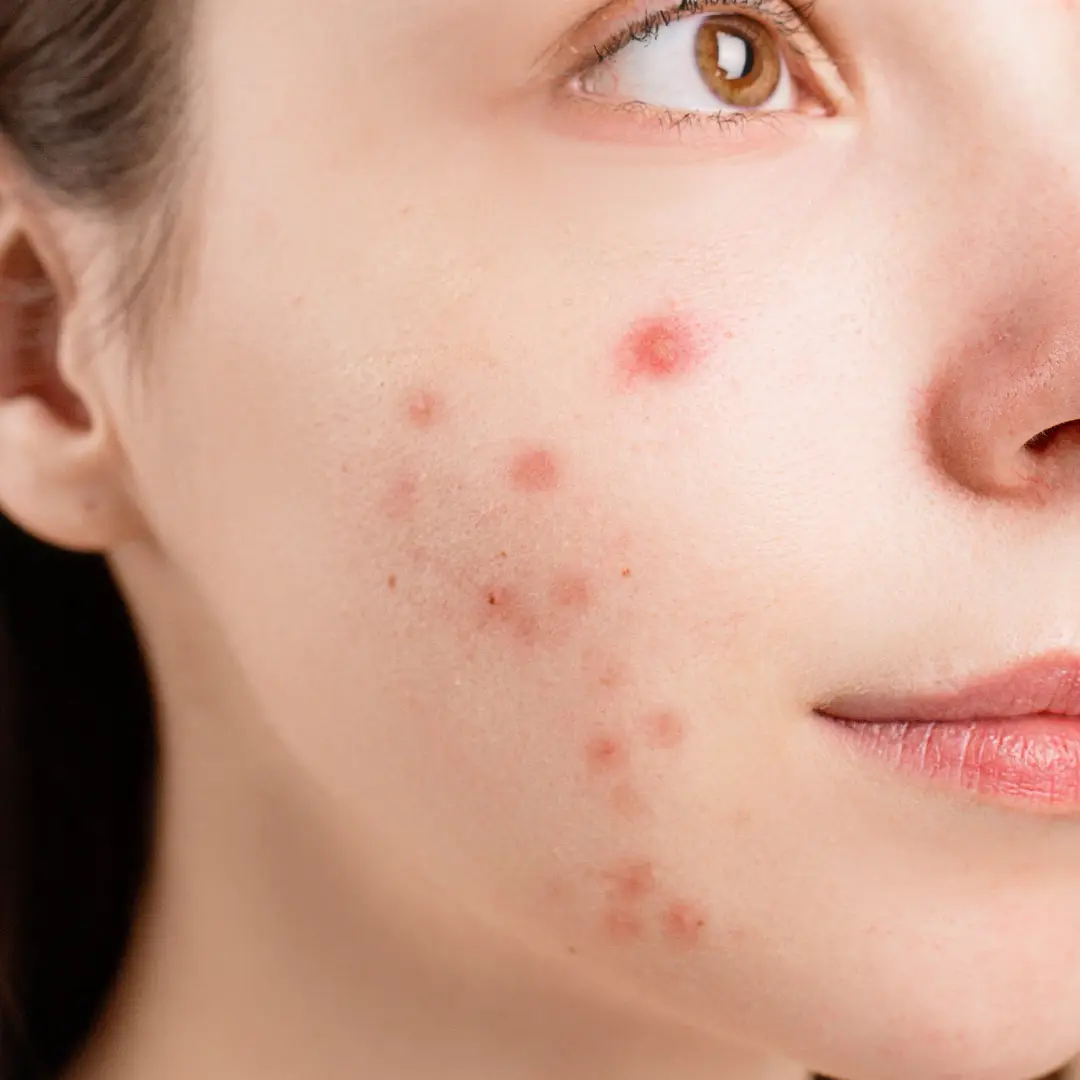 Tratamento para acne na face com dermatologista perto de mim em SP