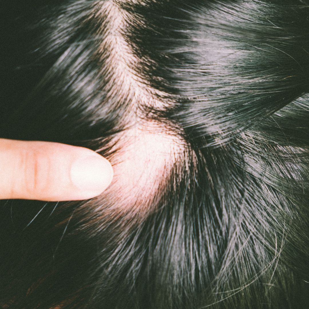 Tratamento para alopecia areata com dermatologista perto de mim em SP
