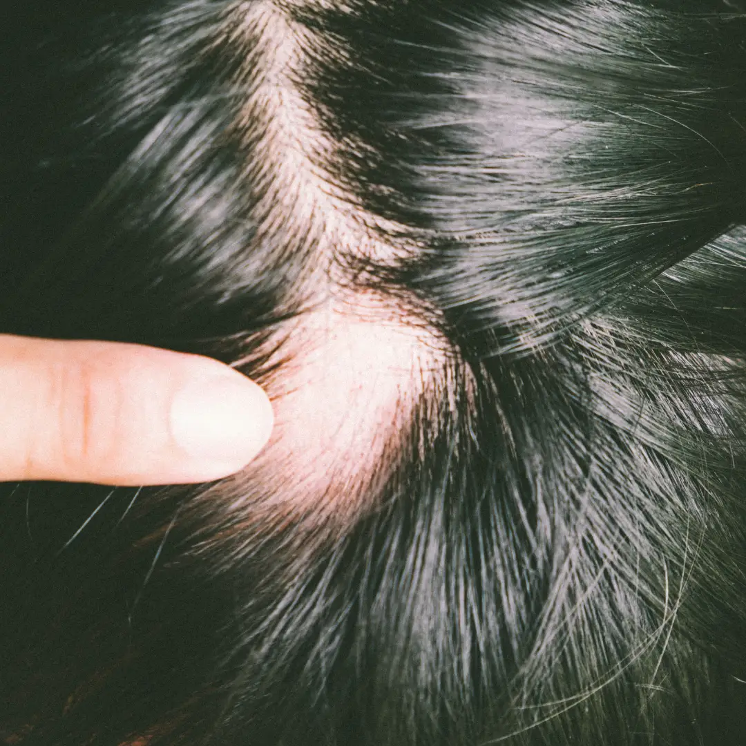 Tratamento para alopecia areata com dermatologista perto de mim em SP