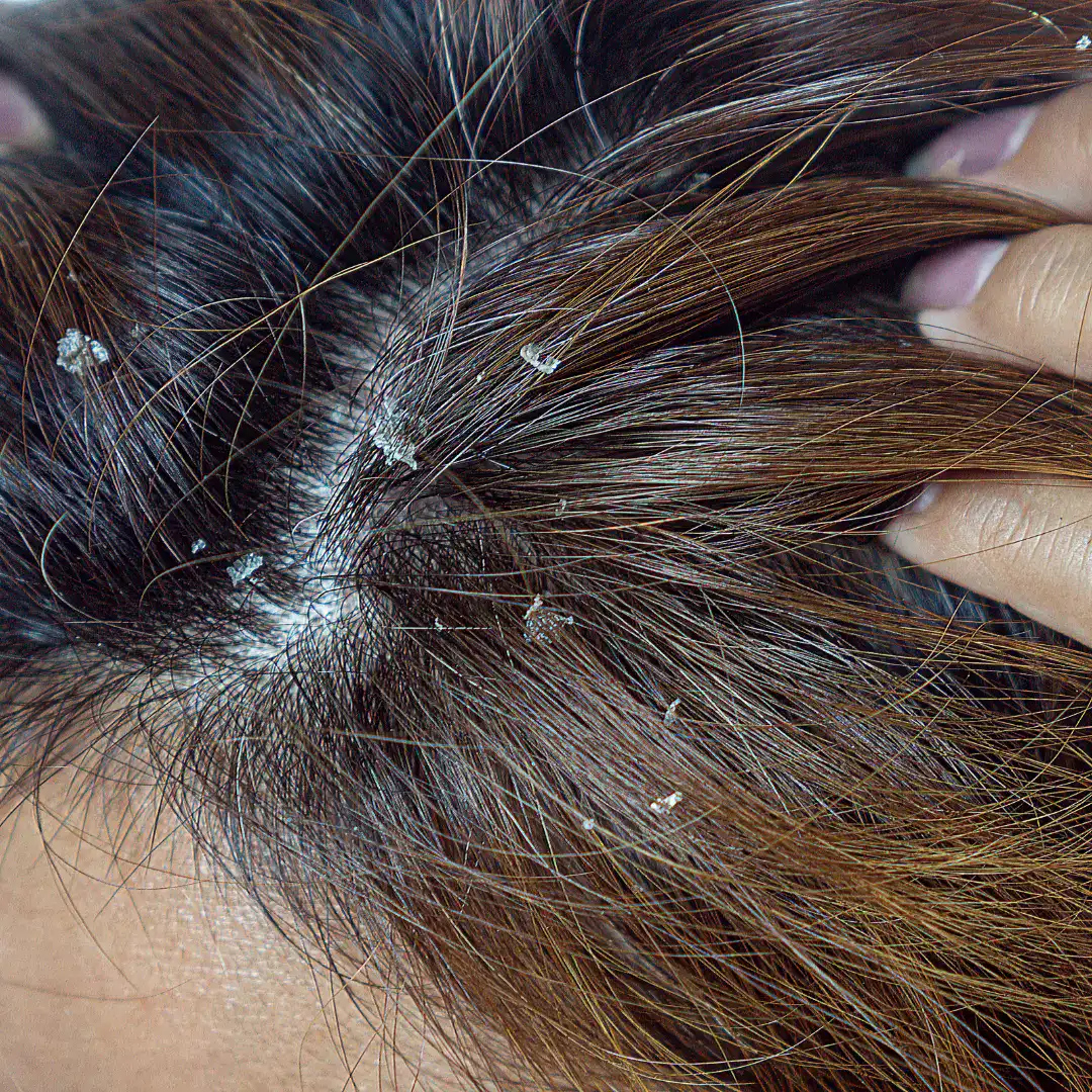Tratamento de caspas com dermatologista perto de mim em SP