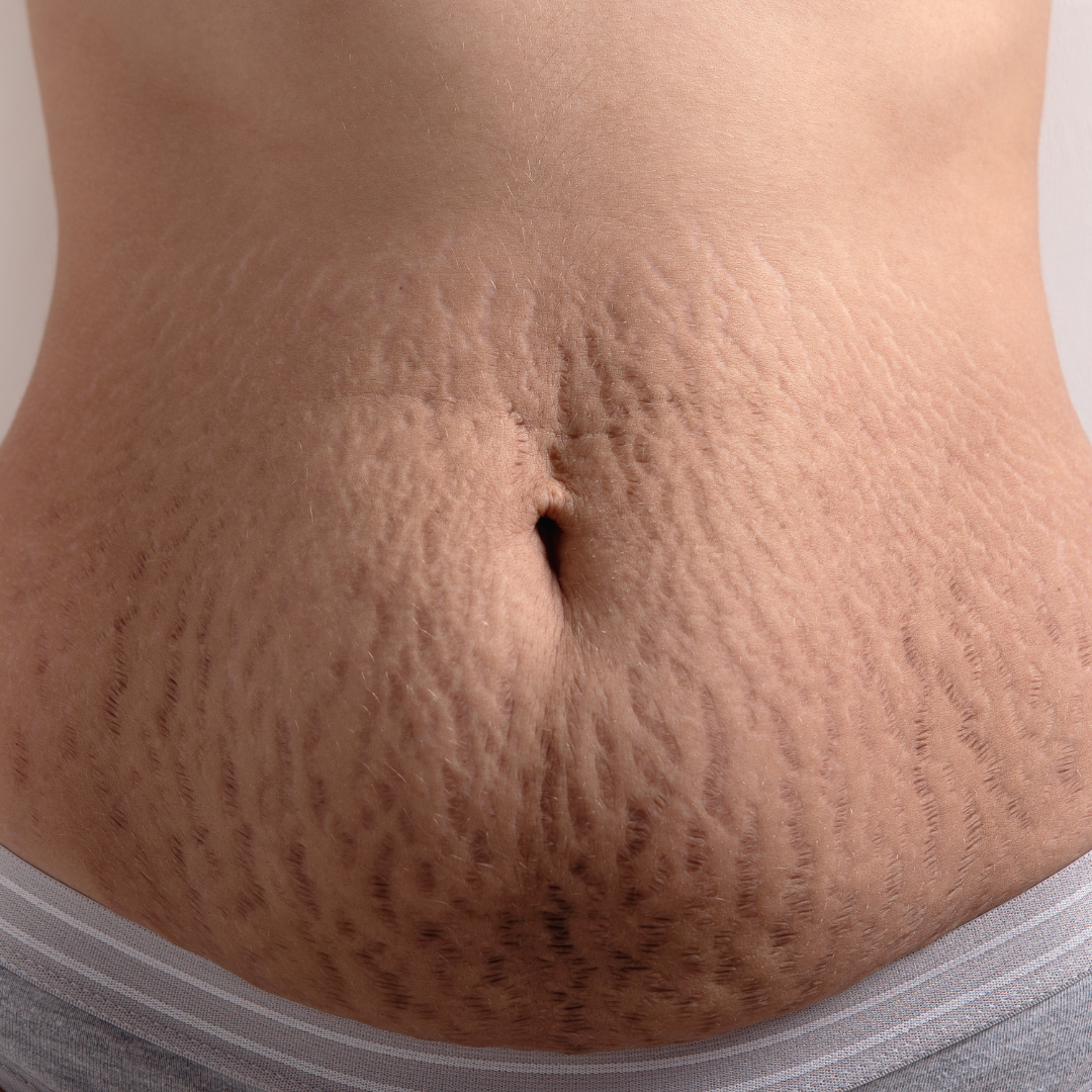 Tratamento para estrias com dermatologista perto de mim em SP
