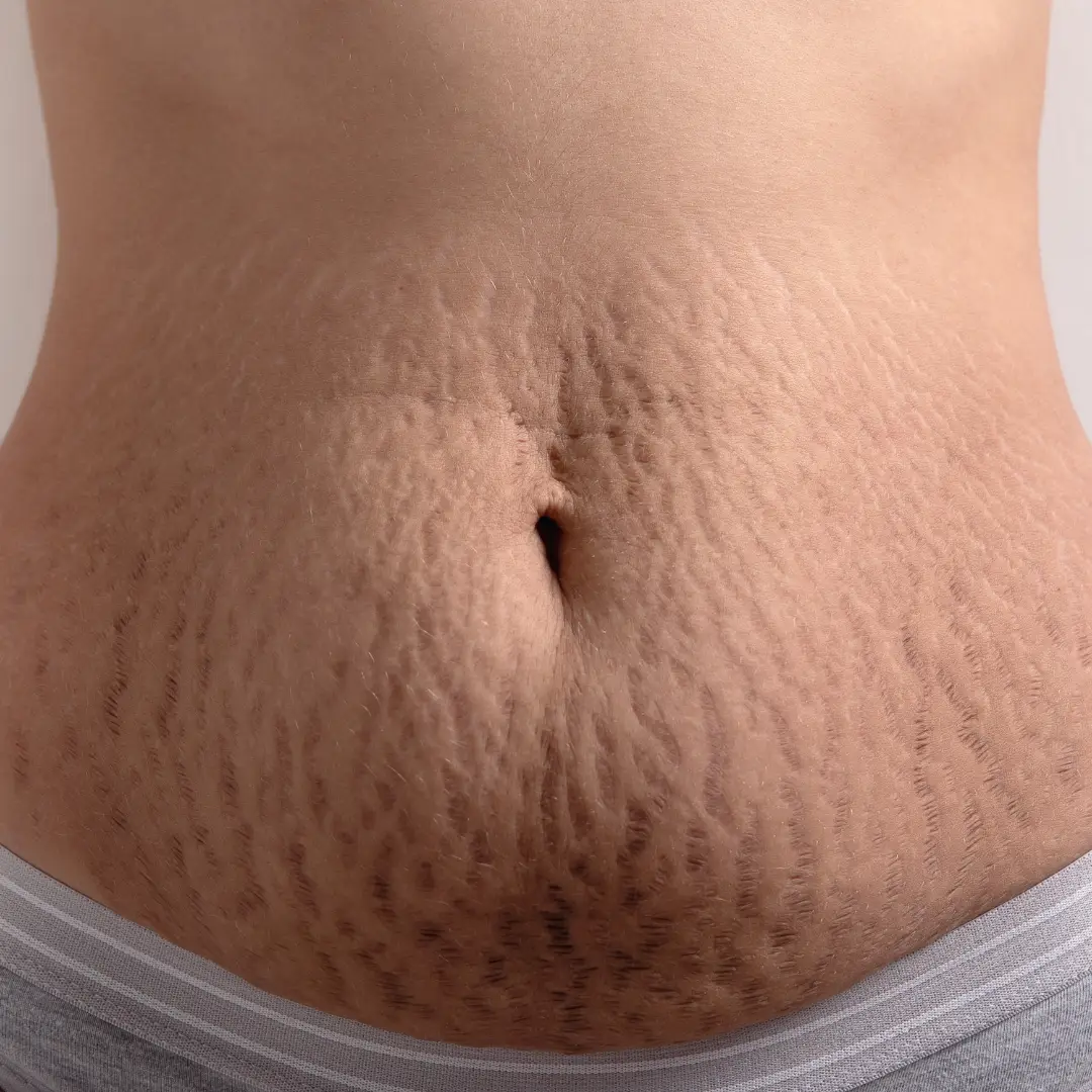 Tratamento para estrias com dermatologista perto de mim em SP
