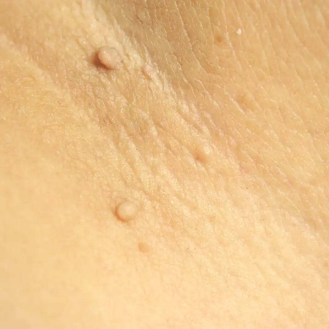 Tratamento de fibromas moles com dermatologista perto de mim em SP