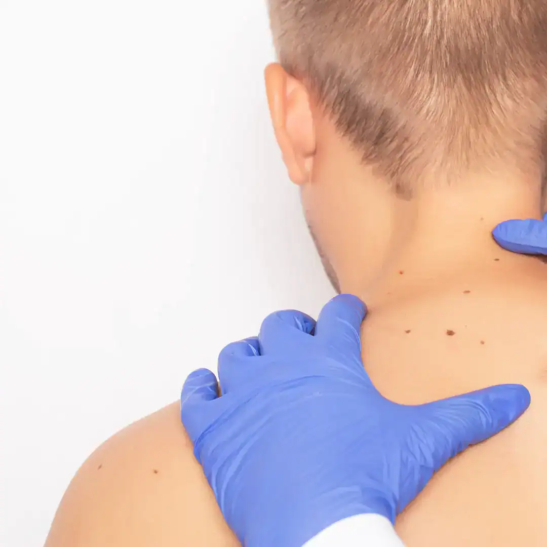 Tratamento de pintas com dermatologista perto de mim em SP