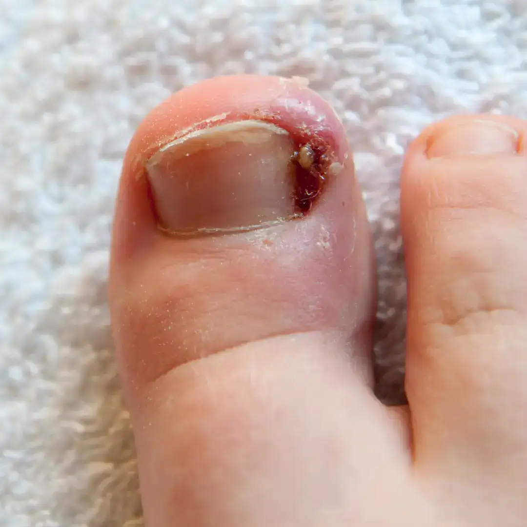 Tratamento de unha encravada com dermatologista perto de mim em SP