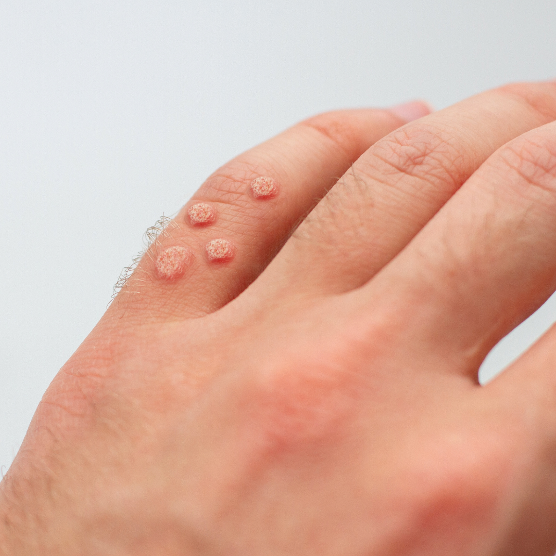 Dermatologista pediátrico. Dermatologia pediátrica. Tratamento de verruga com dermatologista perto de mim em SP