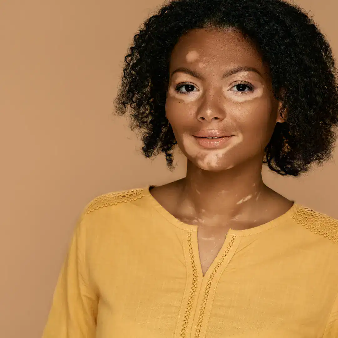Tratamento para vitiligo com dermatologista perto de mim em SP