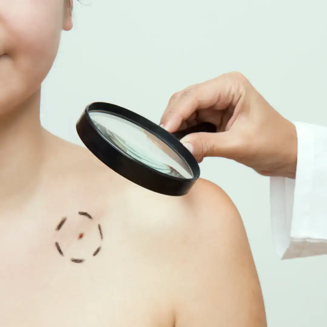 Tratamento de cancer de pele com dermatologista perto de mim em SP