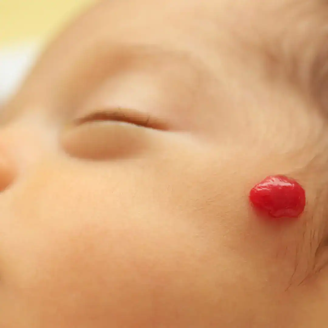 Dermatologia pediátrica. Dermatologista perto de mim. Dermatologia pediátrica. Hemangioma infantil.