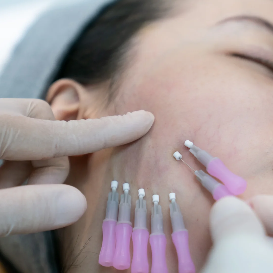 Tratamento com fio de pdo com dermatologista perto de mim em SP